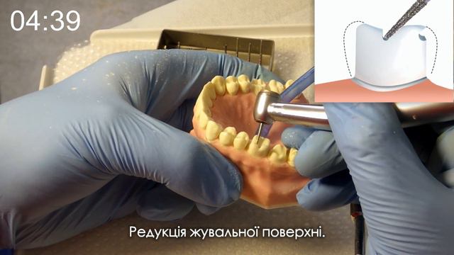 Препарування зуба під коронку за 10 хвилин системою CCQ від доктора Андрія Завадки. смотреть онлайн