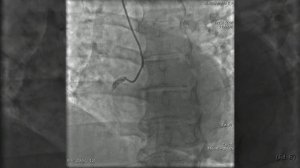 Коронарография при инфаркте