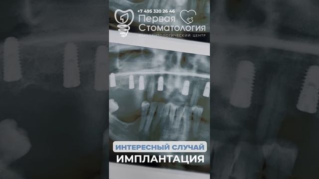 Интересная ситуация. Имплантация зубов пациенту. смотреть онлайн