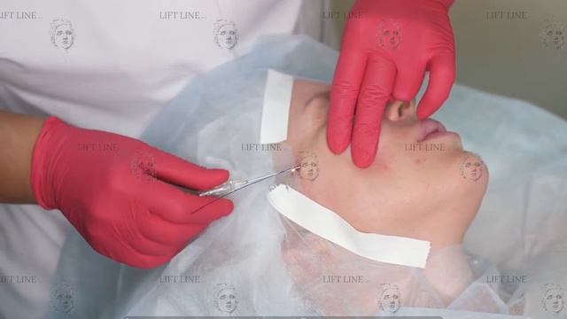 Подтяжка кожи лица нитями - нижняя и средняя треть смотреть онлайн