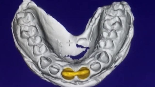 Exo CAD software DESIGNED CROWN смотреть онлайн