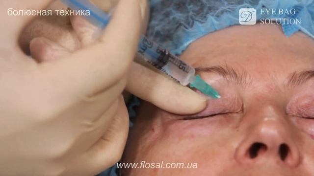 Online-каталог FloSal: мезококтейль от грыжевых 