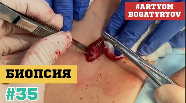 35. БИОПСИЯ образования поясницы