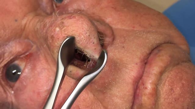Epistaxis | Auburn Medical Group смотреть онлайн