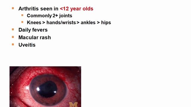 USMLE RX - 8.Анатомия - 3.Патология - 23.Системный Ювенильный идиопатический артрит* (сЮИА) смотреть онлайн