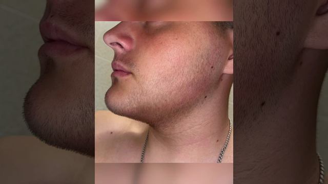 Результаты Применения миноксидила (18лет) смотреть онлайн