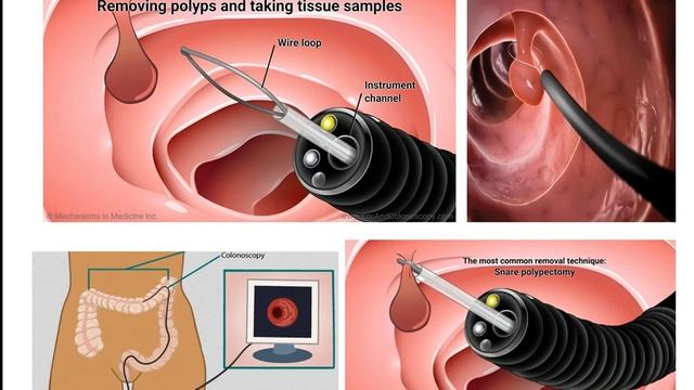 Colonoscopy test in Hindi | कोलोनोस्कोपी टेस्ट क्या है | कैसे होता है | смотреть онлайн