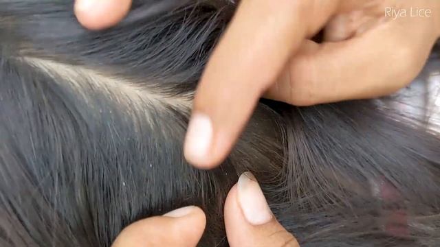 Removing A Lot Of Lice From Long Hair - Take Out All Hundred Lice From Head