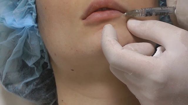 Коррекция формы губ филлерами Stylage. смотреть онлайн