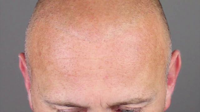Jeroen Smits over Micro Hair Pigmentation (MHP) bij Beauty Care Nederland (BCN) смотреть онлайн