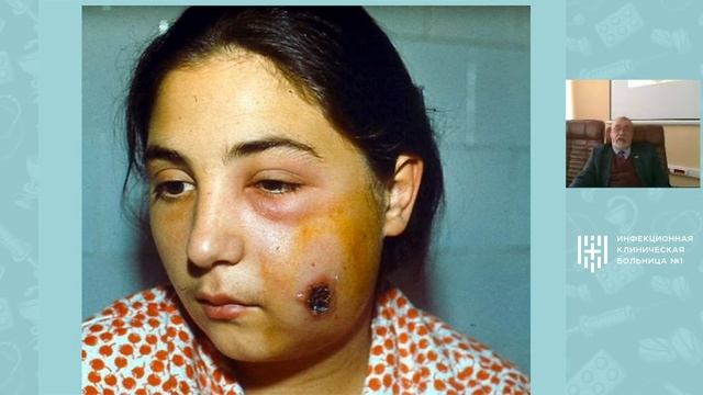 Сибирская язва. Лекция Никифорова Владимира Владимировича в ИКБ №1 смотреть онлайн