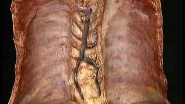 непарная и полунепарные вены смотреть онлайн