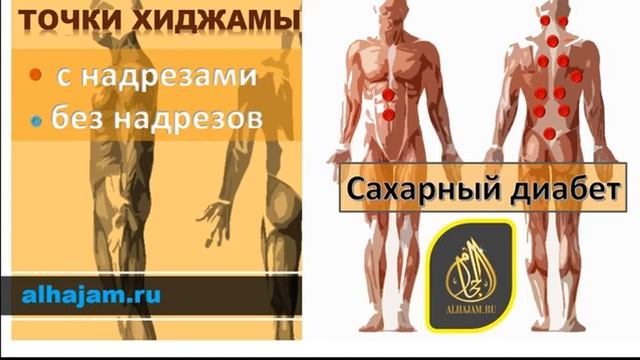 Точки Хиджамы при сахарном диабете