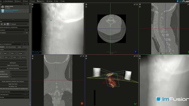 Enhance your 2D-3D Registration from CT to X-ray/Fluoro images with ImFusion Suite смотреть онлайн