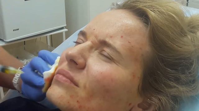 Инъекции, мезопилинг. Акне, поры, жирная кожа. смотреть онлайн