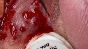 Чистка лица от червяков. Комедоны.