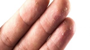 Почему трескается кожа на пальцах рук Лечение