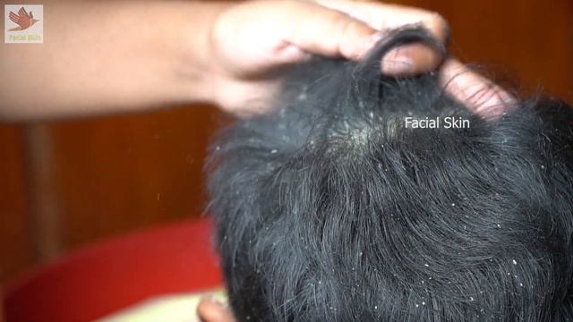 Dandruff Shampoo, Itchy Scratching, Psoriasis Treatment, Huge Flakes Removal #40 смотреть онлайн