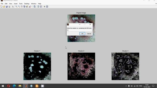 Oral Cancer Detection | Oral Ulcerative Lesions | MATLAB | GLCM | SVM смотреть онлайн