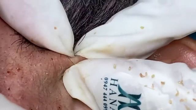 Relaxing Acne Treatment Acnes Treatment  98