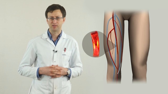 атеросклероз сосудов нижних конечностей, лечение, операции
