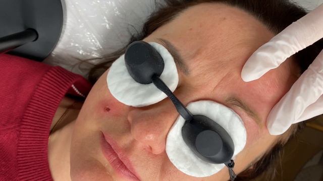 УДАЛЕНИЕ ТАТУАЖА ЛАЗЕРОМ | Процедура полностью | #мк #лазер смотреть онлайн