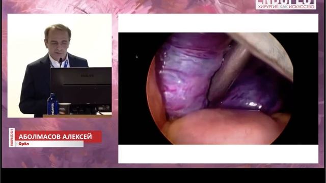 Паховые грыжи ТАПП или ТЭП? смотреть онлайн