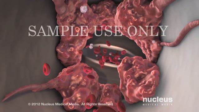 ТГВ и тромбоэмболия легочной артерии