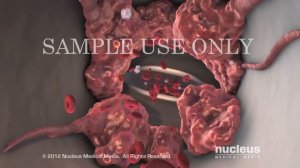 ТГВ и тромбоэмболия легочной артерии