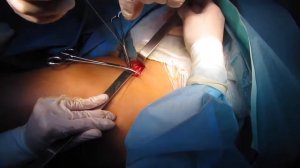 кроссэктомия