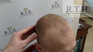 Пересадка волос в 23 года☀️