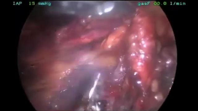 Lymph Node Dissection Para-aortic with Harmonic Ace смотреть онлайн