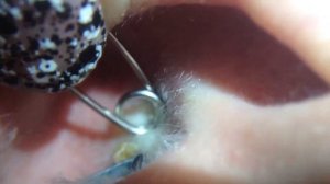 Удаление комедона ушной раковины