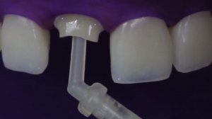 Фиксация стекловолоконного штифта Whitepost и формирование культи зуба при восст. одиночной коронкой