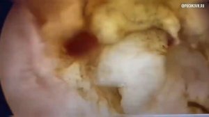 Гистерорезектоскопическое удаление субмукозной миомы матки