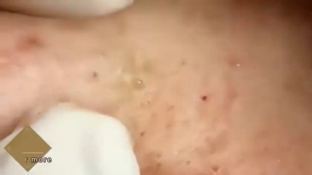 Pimple,Blackhead,Acne