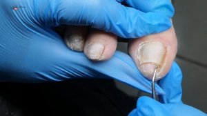 Зачистка ногтей на ногах. Возрастной педикюр. Скрученные ногти