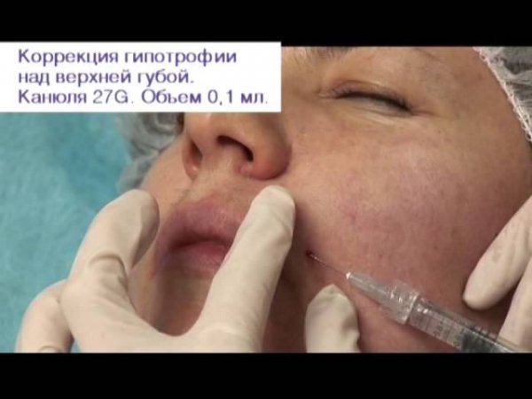 31 КАМЕЛИНА - модель Е периоральная Regenyal Idea