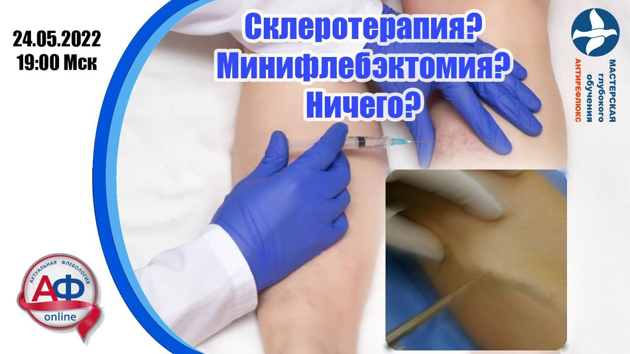 Склеротерапия? Минифлебэктомия? Ничего? смотреть онлайн