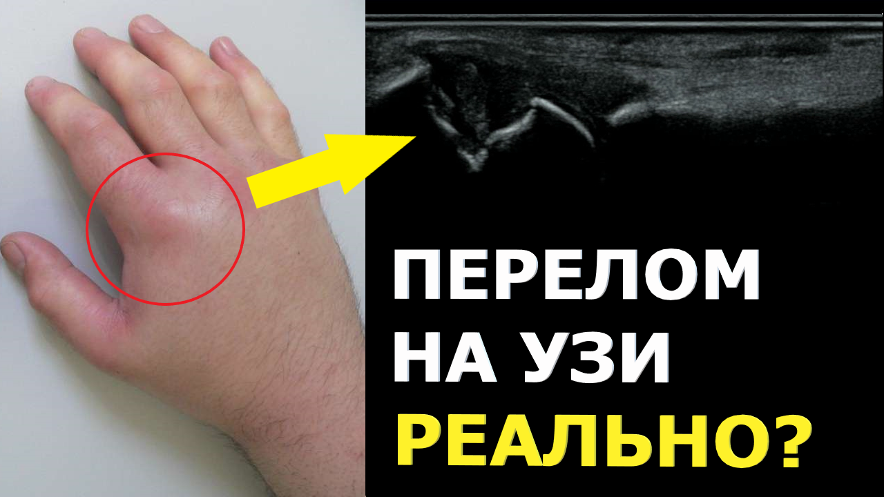 Как выглядит ПЕРЕЛОМ кости на УЗИ? смотреть онлайн