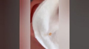 Самое залипательное видео давить прыщи Черные точки