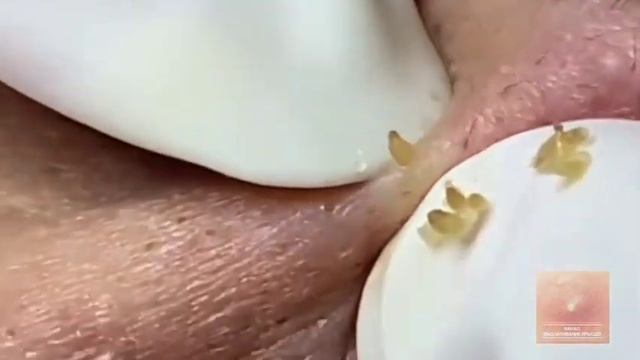 ✅ Чистка лица #5 смотреть онлайн