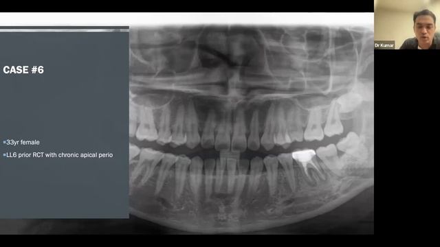 Zoom Webinar: An Alternative To Titanium Implants - Zeramex Ceramic Implants FULL VERSION смотреть онлайн