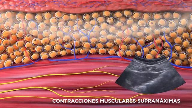 Emsculpt® Hifem® Body Gandia (Abdomen) смотреть онлайн
