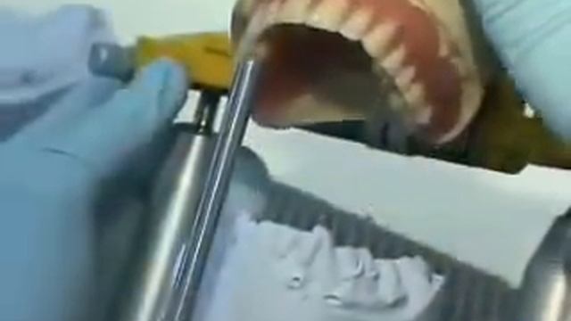 Полный съемный протез с фиксацией на имплантах при помощи магнитных креплений смотреть онлайн