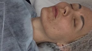 мононити из полидиоксанона в субментальную зону