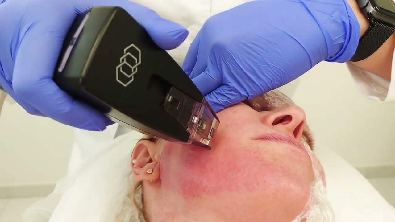 Микроигольчатый RF лифтинг лица - Morpheus 8 смотреть онлайн