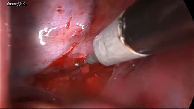 Asvide: Uniportal video-assisted thoracoscopic surgery right thoracic duct ligation смотреть онлайн