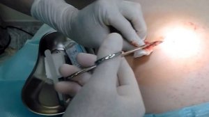 Удаление липомы с наложением шва по Донати