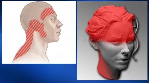 2.32. Массаж при синдроме головной боли, мигрени | Медицинский массаж. Цикл 2